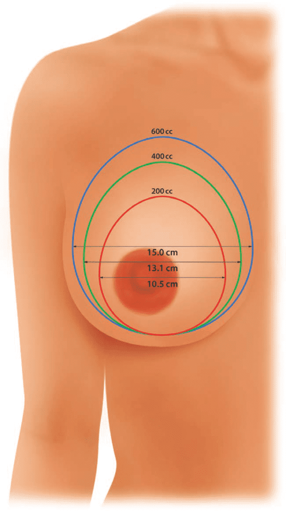 Illustration-depicting-breast-implant-volumes-and-diameters-As-the-implant-volume